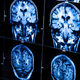 Illustration for article titled Physicians in China treat addictions by destroying the brain's pleasure center